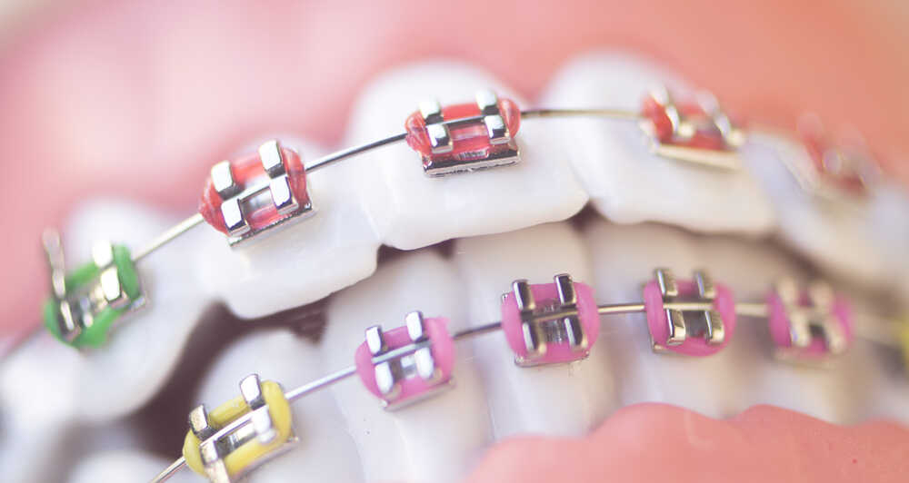 Felnőtt korban lehet a fogakat szabályozni?