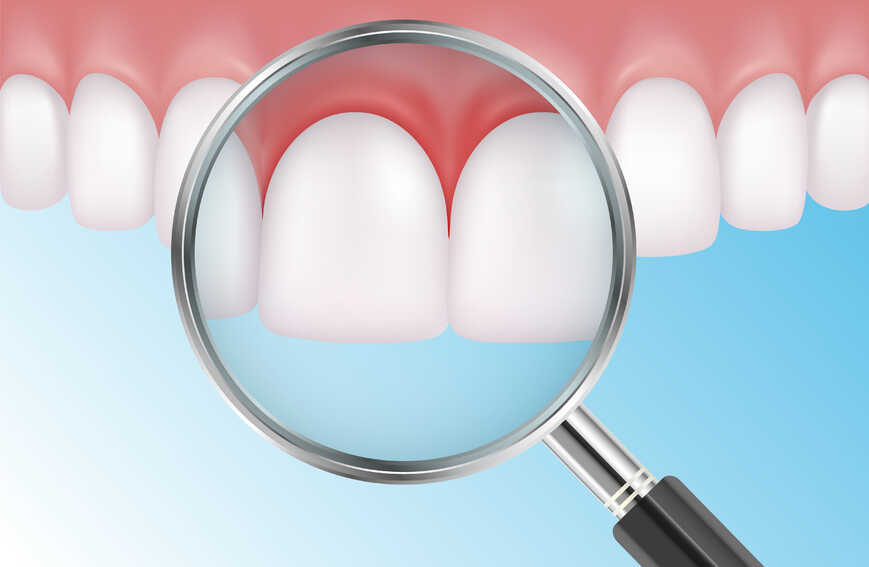 tudnivalók a lyukas fogakról
