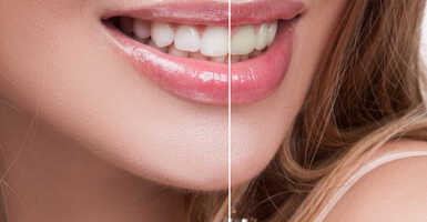 Ismerd meg a dentálhigiéniás kezeléseket?